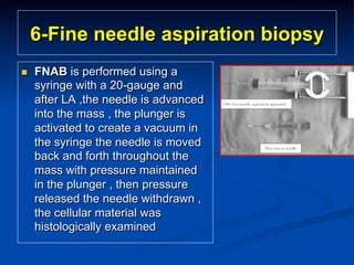 6-Fine needle aspiration biopsy
n 

FNAB is performed using a
syringe with a 20-gauge and
after LA ,the needle is advanced
into the mass , the plunger is
activated to create a vacuum in
the syringe the needle is moved
back and forth throughout the
mass with pressure maintained
in the plunger , then pressure
released the needle withdrawn ,
the cellular material was
histologically examined

 