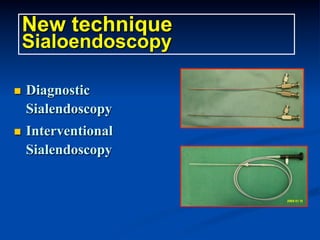 New technique
Sialoendoscopy
n 

Diagnostic
Sialendoscopy

n 

Interventional
Sialendoscopy

 