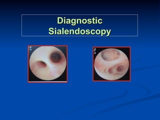Diagnostic
Sialendoscopy

 