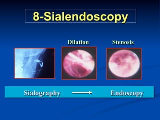8-Sialendoscopy
Dilation

Sialography

Stenosis

Endoscopy

 