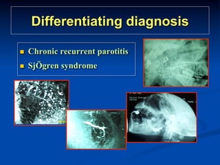 Differentiating diagnosis
n 

Chronic recurrent parotitis

n 

SjÖgren syndrome

 