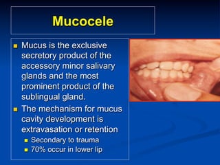 Mucocele
n 

n 

Mucus is the exclusive
secretory product of the
accessory minor salivary
glands and the most
prominent product of the
sublingual gland.
The mechanism for mucus
cavity development is
extravasation or retention
n 
n 

Secondary to trauma
70% occur in lower lip

 