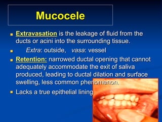 Mucocele
"

"
"

"

Extravasation is the leakage of fluid from the
ducts or acini into the surrounding tissue.
Extra: outside, vasa: vessel
Retention: narrowed ductal opening that cannot
adequately accommodate the exit of saliva
produced, leading to ductal dilation and surface
swelling, less common phenomenon.
Lacks a true epithelial lining

 