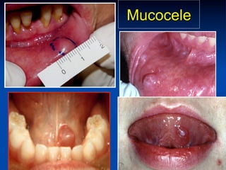 Mucocele

 