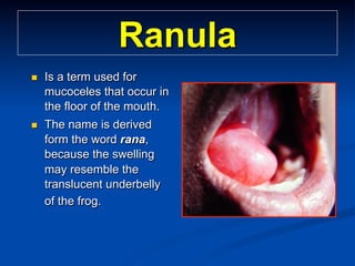 Ranula
n 

Is a term used for
mucoceles that occur in
the floor of the mouth.

n 

The name is derived
form the word rana,
because the swelling
may resemble the
translucent underbelly
of the frog.

 