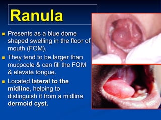 Ranula
n 

n 

n 

Presents as a blue dome
shaped swelling in the floor of
mouth (FOM).
They tend to be larger than
mucocele & can fill the FOM
& elevate tongue.
Located lateral to the
midline, helping to
distinguish it from a midline
dermoid cyst.

 