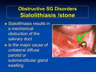 Obstructive SG Disorders

Sialolithiasis /stone
Sialolithiasis results in
a mechanical
obstuction of the
salivary duct
n  Is the major cause of
unilateral diffuse
parotid or
submandibular gland
swelling
n 

 