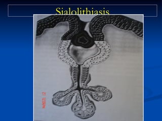 Sialolithiasis

 