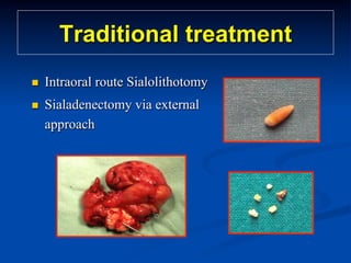 Traditional treatment
n 

Intraoral route Sialolithotomy

n 

Sialadenectomy via external
approach

 