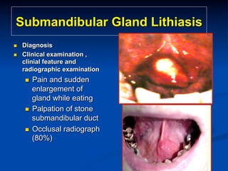 Submandibular Gland Lithiasis
n 
n 

Diagnosis
Clinical examination ,
clinial feature and
radiographic examination

Pain and sudden
enlargement of
gland while eating
n  Palpation of stone
submandibular duct
n  Occlusal radiograph
(80%)
n 

 