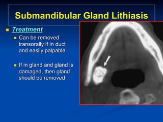 Submandibular Gland Lithiasis
n 

Treatment
n 

Can be removed
transorally if in duct
and easily palpable

n 

If in gland and gland is
damaged, then gland
should be removed

 
