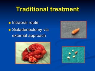 Traditional treatment
n 

Intraoral route

n 

Sialadenectomy via
external approach

 
