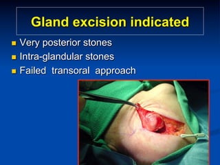 Gland excision indicated
Very posterior stones
n  Intra-glandular stones
n  Failed transoral approach
n 

 