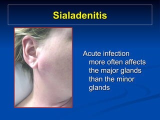 Sialadenitis

Acute infection
more often affects
the major glands
than the minor
glands

 