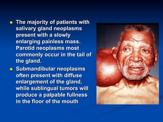 n 

n 

The majority of patients with
salivary gland neoplasms
present with a slowly
enlarging painless mass.
Parotid neoplasms most
commonly occur in the tail of
the gland.
Submandibular neoplasms
often present with diffuse
enlargement of the gland,
while sublingual tumors will
produce a palpable fullness
in the floor of the mouth

 