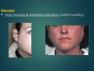 Diseases:
 Viral( mumps) & bacterial infections- painful swelling .
 