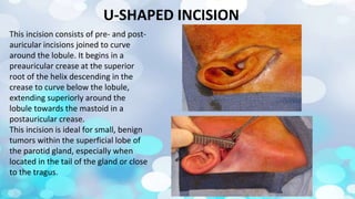 Fusiform Shape Incision Surgical anatomy of Salivary glands - ORAL AND MAXILLOFACIAL SURGERY | PPTX