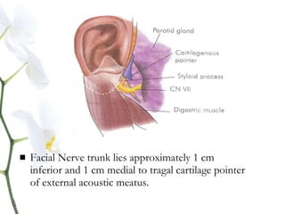  Facial Nerve trunk lies approximately 1 cm
inferior and 1 cm medial to tragal cartilage pointer
of external acoustic meatus.
 