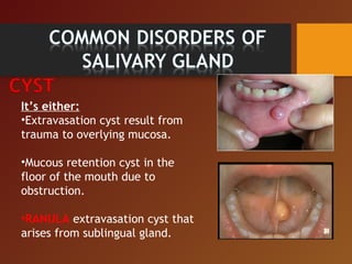 It’s either:
•Extravasation cyst result from
trauma to overlying mucosa.
•Mucous retention cyst in the
floor of the mouth due to
obstruction.
•RANULA extravasation cyst that
arises from sublingual gland.
 