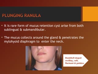 • It is rare form of mucus retention cyst arise from both
sublingual & submandibular.
• The mucus collects around the gland & penetrates the
mylohyoid diaphragm to enter the neck.
Dumbbell shaped
swelling , soft,
fluctuant & painless
 