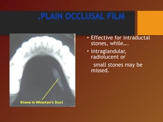 • Effective for intraductal
stones, while….
• intraglandular,
radiolucent or
small stones may be
missed.
 