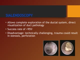 • Allows complete exploration of the ductal system, direct
visualization of duct pathology
• Success rate of >95%2
• Disadvantage: technically challenging, trauma could result
in stenosis, perforation
 