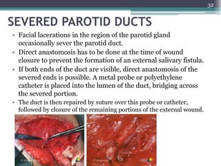 SEVERED PAROTID DUCTS
• Facial lacerations in the region of the parotid gland
occasionally sever the parotid duct.
• Direct anastomosis has to be done at the time of wound
closure to prevent the formation of an external salivary fistula.
• If both ends of the duct are visible, direct anastomosis of the
severed ends is possible. A metal probe or polyethylene
catheter is placed into the lumen of the duct, bridging across
the severed portion.
• The duct is then repaired by suture over this probe or catheter,
followed by closure of the remaining portions of the external wound.
32
 