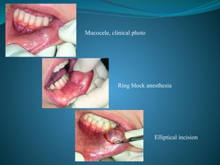 SALIVARY GLANDS pathology PPT FINAL.pptx