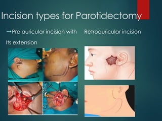 Preauricular Incision Steps Comprehensive Guide to Salivary Gland Surgery: Anatomy, Pathology, and ...