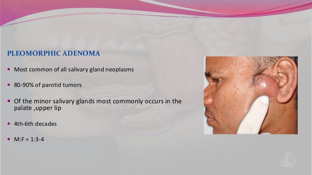 Salivary gland tumor