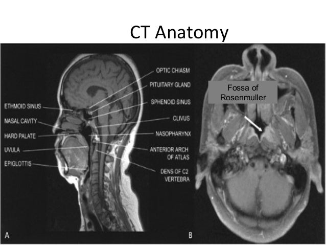 Nasopharyngeal Carcinoma