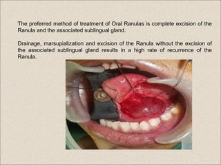 Salivary surgery | PPT
