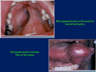 Blue-pigmented mass of the posterior
lateral hard palate.
Mucoepidermoid carcinoma.
Mass of the tongue
 