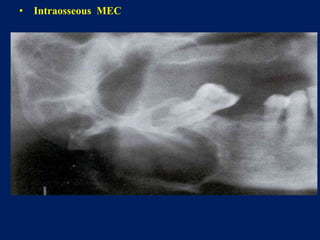 • Intraosseous MEC
 
