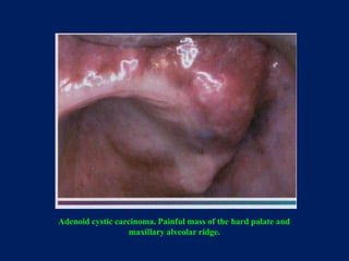 Adenoid cystic carcinoma. Painful mass of the hard palate and
maxillary alveolar ridge.
 