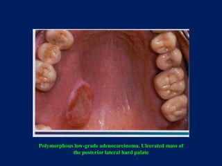 Polymorphous low-grade adenocarcinoma. Ulcerated mass of
the posterior lateral hard palate
 