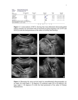 7 
Figure 3. A meta-analysis of RCTs showing that trans-abdominal ultrasound-guided 
embryo transfers are associated with an increased on-going pregnancy rate in IVF and 
ICSI [5] (with the kind permission of the editor of Fertility and Sterility). 
Figure 4. Measuring the utero-cervical angle by transabdominal ultrasonography (a) 
no angle, (b) small angle (< 30 degrees), (c) moderate angle (30 to 60 degrees), (d) 
large angle (> 60 degrees) [7] (with the kind permission of the editor of Human 
Reproduction) 
 