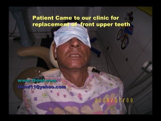 Patient Came to our clinic for
     replacement of front upper teeth




www.thind.com
thind11@yahoo.com
 