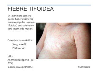 FIEBRE TIFOIDEA
CENETEC(2009)
En la primera semana
puede haber exantema
maculo-papular (roseola
tifoídica) en abdomen y
cara interna de muslos
Complicaciones 6-12%
Sangrado GI
Perforación
Labs:
Anemia/leucopenia (20-
25%)
eosinopenia (70/80%)
 