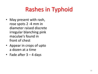 Rashes in Typhoid
• May present with rash,
rose spots 2 -4 mm in
diameter raised discrete
irregular blanching pink
maculae's found in
front of chest
• Appear in crops of upto
a dozen at a time
• Fade after 3 – 4 days
30
 
