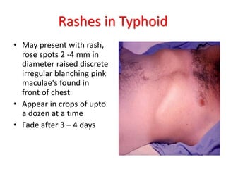 Rashes in Typhoid
• May present with rash,
rose spots 2 -4 mm in
diameter raised discrete
irregular blanching pink
maculae's found in
front of chest
• Appear in crops of upto
a dozen at a time
• Fade after 3 – 4 days
 