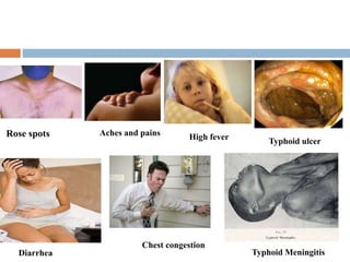 Rose spots High fever
Diarrhea Typhoid Meningitis
Aches and pains
Chest congestion
Typhoid ulcer
 