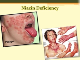 Niacin Deficiency 
 