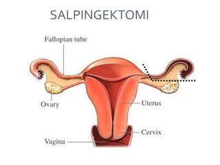 SALPINGEKTOMI
 