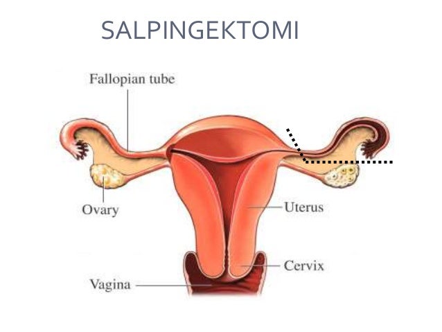 Salpingectomy