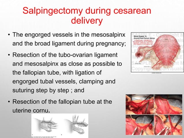 Salpingectomy Machine Salpingectomy for ovarian risk reduction | PPTX