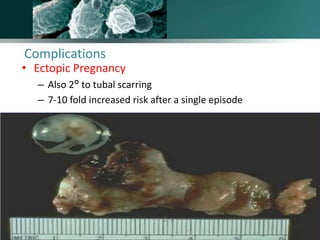Complications
• Ectopic Pregnancy
– Also 2° to tubal scarring
– 7-10 fold increased risk after a single episode
www.freelivedoctor.com
 