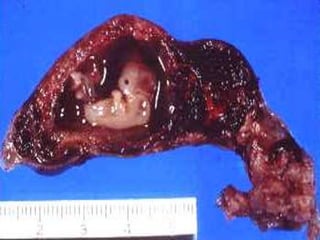 Complications
• Ectopic Pregnancy
www.freelivedoctor.com
 