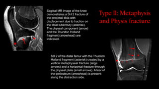 Salter-Harris-II-Tibial-Fracture-Kyra-Frost-MS4-Dr.M.-Kumaravel-Copy-1.pdf