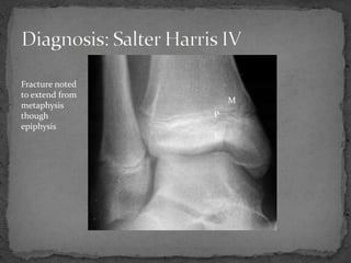 M
P
E
Fracture noted
to extend from
metaphysis
though
epiphysis
 
